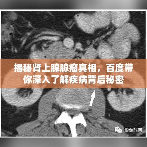 揭秘腎上腺腺瘤真相，百度帶你深入了解疾病背后秘密