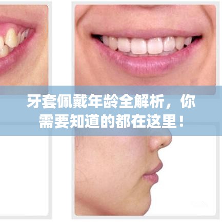 牙套佩戴年齡全解析，你需要知道的都在這里！